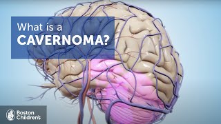 Ischemic and Hemorrhagic Strokes  High Yield [upl. by Zia]