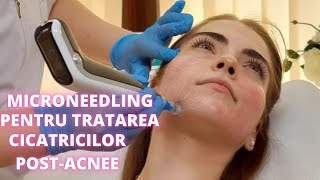 Microneedling Dermapen pentru tratarea cicatricilor postacnee  DermaBeauty Clinique [upl. by Idelia70]