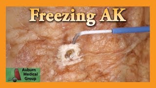 Freezing Hand Actinic Keratosis with Liquid Nitrogen  Auburn Medical Group [upl. by Lesig]