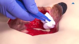 How to Effectively Cleanse and Debride a Wound  Wound Cleansing and Debridement  Ausmed Education [upl. by Nomaj]