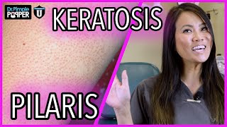 HOW TO treat KERATOSIS PILARISSTRAWBERRY SKINCHICKEN SKIN at home  Ingrown hair on arms amp legs🌼 [upl. by Jenn]