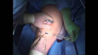 ACL Surgery  First Incision [upl. by Ross]