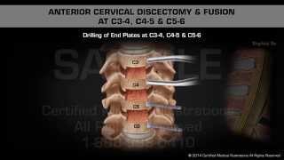 Anterior Cervical Discectomy amp Fusion at C34 C45 amp C56 [upl. by Cordelie465]