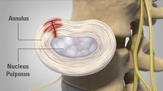 Patient Animation  Lumbar Degenerative Disc Disease [upl. by Shipley702]