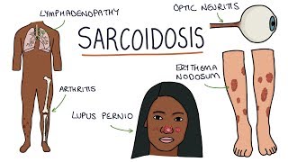 Sarcoidosis pathophysiology clinical aspects and management [upl. by Farrow]