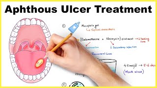 Aphthous ulcer stomatitis Canker sore treatment [upl. by Dahlstrom]