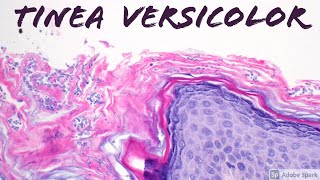 Tinea VersicolorPityriasis Versicolor Malassezia aka Pityrosporum Skin Infection Dermatology [upl. by Josiah]