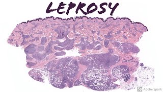 Effects of LEPROSY on SKIN  Symptoms  World Leprosy Day  Dr Rashmi Ravindra  Doctors Circle [upl. by Barram402]