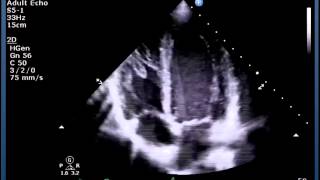 Congenital Heart Defects Quick amp EZ Episode 1 [upl. by Harwill]