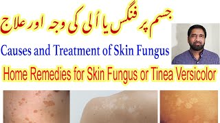 Fungal Skin Infection  Fungal Infection  Tinea Versicolor Treatment  Skin Fungus Yeast Infection [upl. by Herschel]