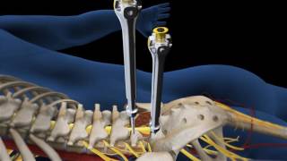 Lumbar Fusion of L5 S1 Animation [upl. by Attey]