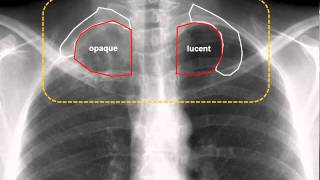 Pancoast Tumor amp Horner Syndrome [upl. by Yrrum256]