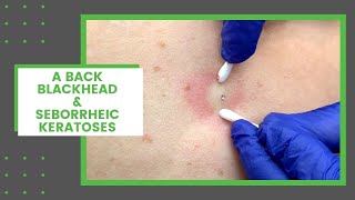 A Back Blackhead amp Seborrheic Keratoses  Dr Derm [upl. by Artapoelc]