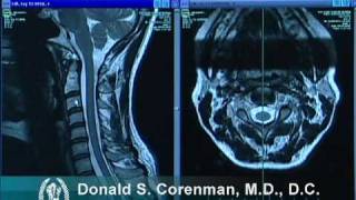 How to Read a MRI of the Normal Cervical Spine Neck  Colorado Spine Expert [upl. by Annehsat]