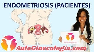 ENDOMETRIOSIS PACIENTES Síntomas diagnóstico tratamiento fertilidad Ginecología y Obstetricia [upl. by Berthe]