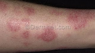 Varicose Eczema  7 Facts About Varicose Eczema You Must Know [upl. by Asyal886]